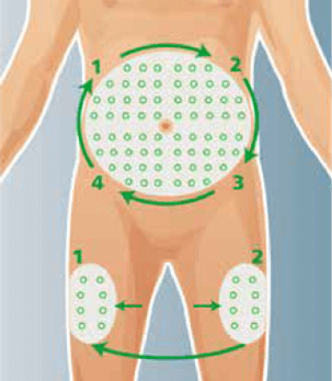 Demystifying injections