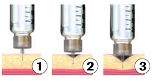 Demystifying injections